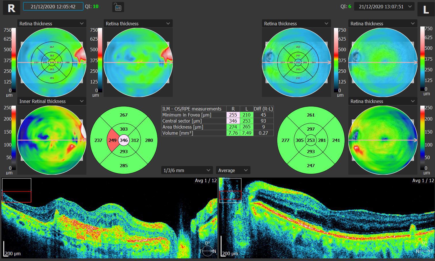 Normal vs Glaucoma nerve fiber analysis